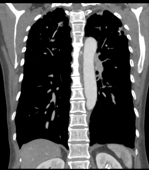 Bronchial artery aneurysms (Radiopaedia 42282-45385 Coronal C+ delayed 45).png