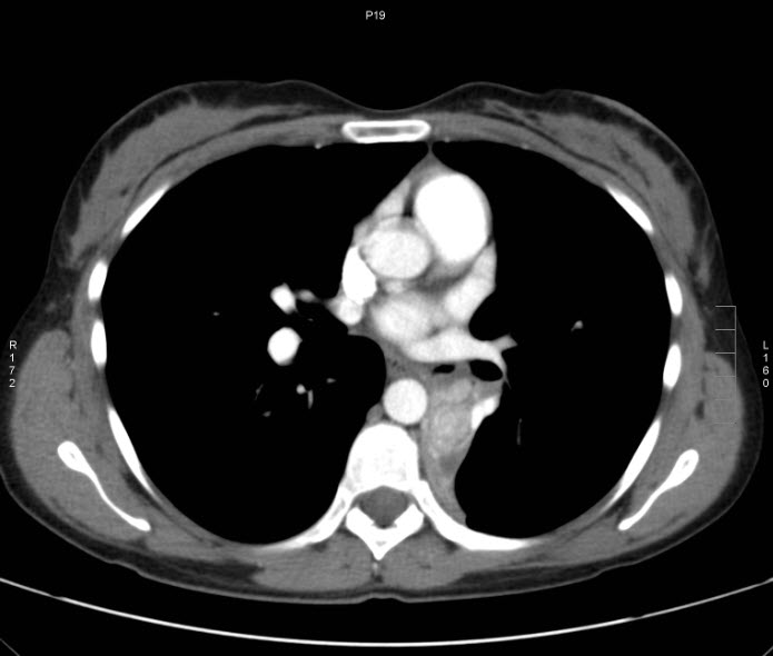 File:Bronchial carcinoid tumor (Radiopaedia 15042-42507 B 5).jpg