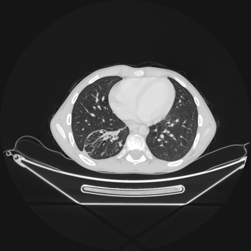 Bronchial carcinoid tumor (Radiopaedia 57187-64090 Axial lung window 56).jpg