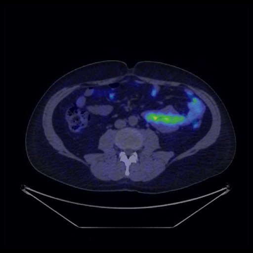 Bronchial carcinoid tumor (Radiopaedia 67377-76765 68Ga-DOTATATE PET-CT 55).jpg