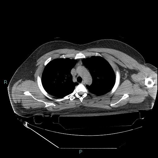 Bronchial carcinoid tumor (Radiopaedia 78272-90870 Axial non-contrast 29).jpg