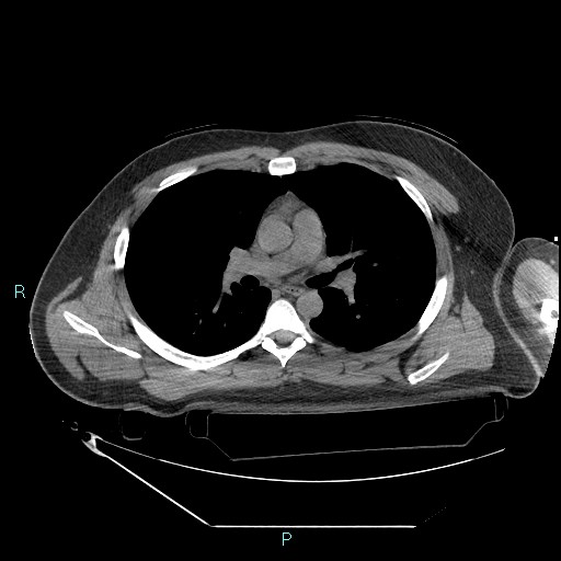 Bronchial carcinoid tumor (Radiopaedia 78272-90870 Axial non-contrast 47).jpg