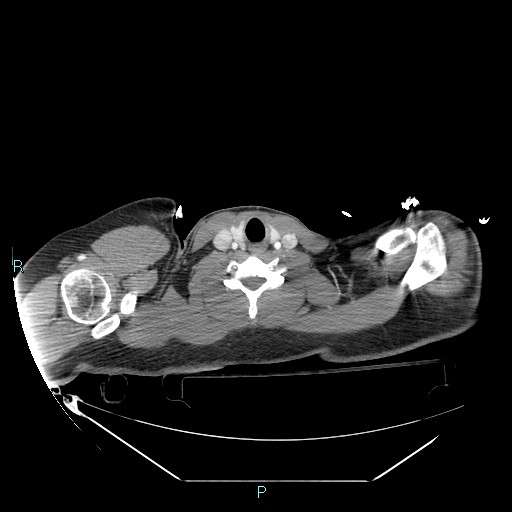 File:Bronchial carcinoid tumor (Radiopaedia 78272-90870 B 1).jpg