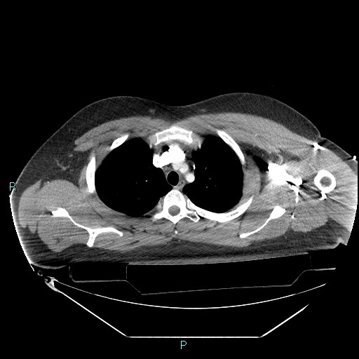 File:Bronchial carcinoid tumor (Radiopaedia 78272-90870 B 33).jpg