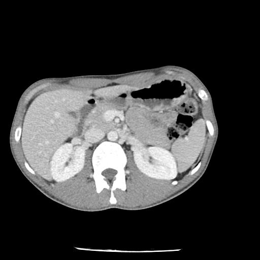 File:Bronchial carcinoid tumor causing right lower lobe collapse (Radiopaedia 83495-98594 A 60).jpg