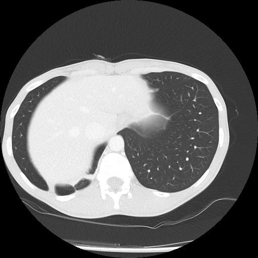 Bronchial carcinoid tumor causing right lower lobe collapse (Radiopaedia 83495-98594 Axial lung window 47).jpg