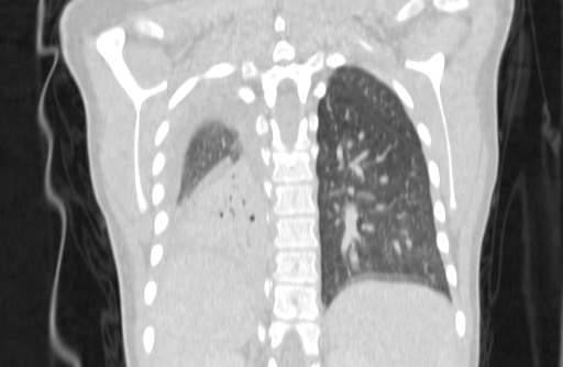Bronchial mucoepidermoid carcinoma (Radiopaedia 57023-63895 Coronal lung window 74).jpg