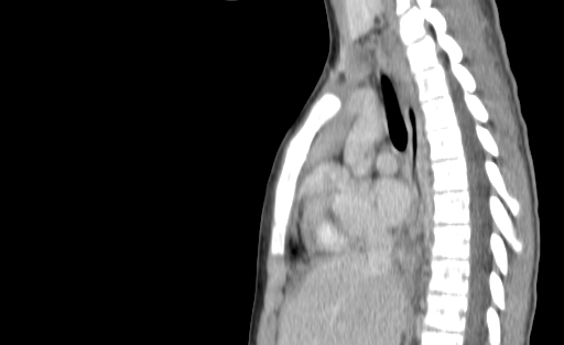 Bronchial mucoepidermoid carcinoma (Radiopaedia 57023-63895 Sagittal 116).jpg