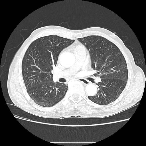 Bronchocele (Radiopaedia 17097-16795 Axial lung window 60).jpg