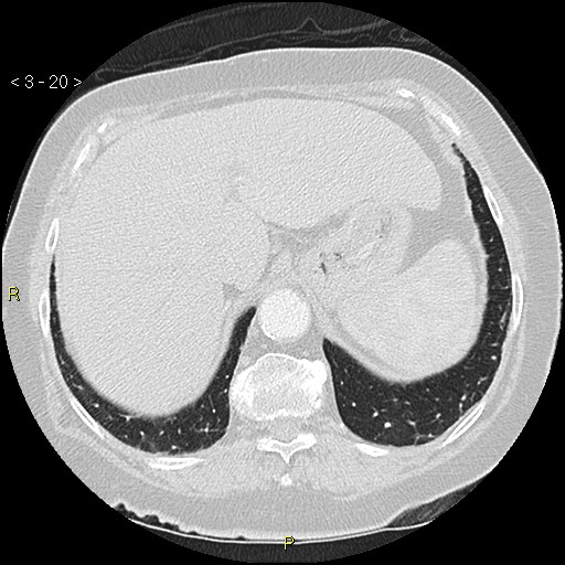 File:Bronchogenic carcinoma as an incidental finding (Radiopaedia 16453-16130 Axial lung window 20).jpg