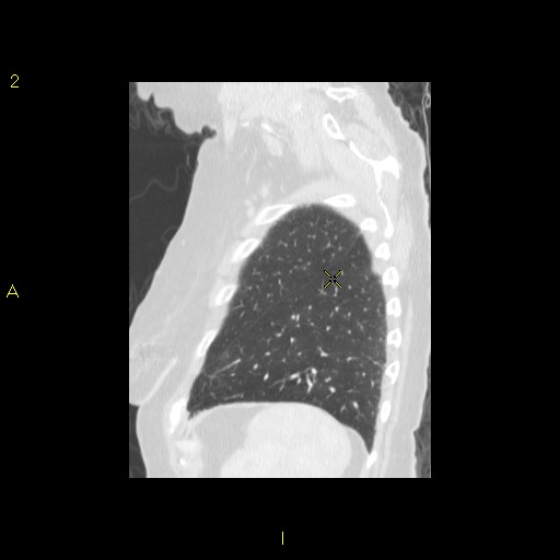 File:Bronchogenic carcinoma as an incidental finding (Radiopaedia 16453-16130 Sagittal lung window 10).jpg