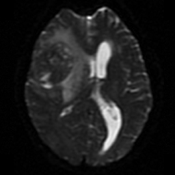 File:Bronchogenic carcinoma brain metastasis (Radiopaedia 9286-9969 Axial DWI 1).jpg