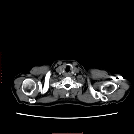 File:Bronchogenic carcinoma with left atrial large deposit - T4N3M1a (Radiopaedia 42316-45428 A 3).jpg