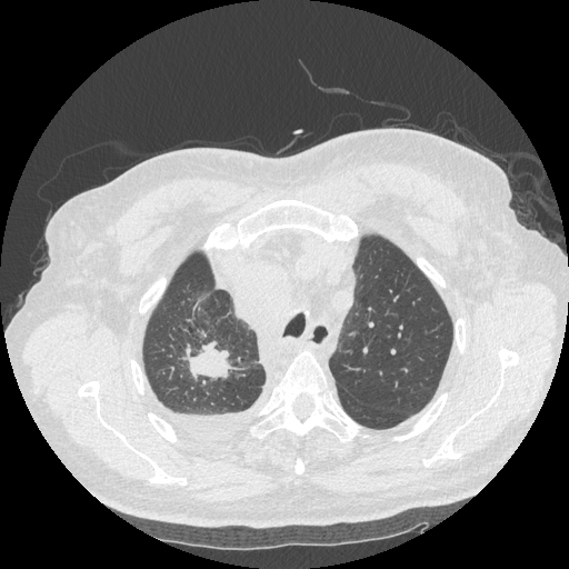 Bronchogenic carcinoma with metastatic lymphadenopathy (Radiopaedia 37671-39569 Axial lung window 13).jpg