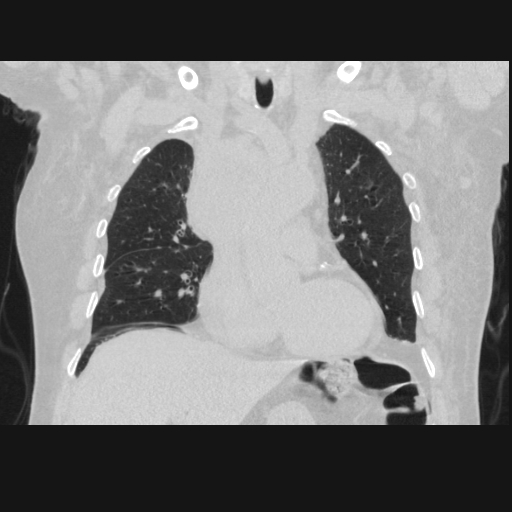 File:Bronchogenic carcinoma with metastatic lymphadenopathy (Radiopaedia 37671-39569 Coronal lung window 18).jpg