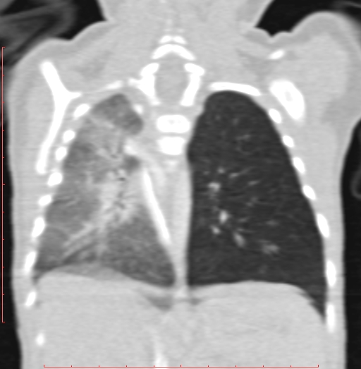 File:Bronchogenic cyst (Radiopaedia 78599-91409 Coronal lung window 154).jpg