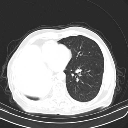 Bronchopleural fistula - postoperative complication (Radiopaedia 21020-20947 Axial lung window 38).jpg