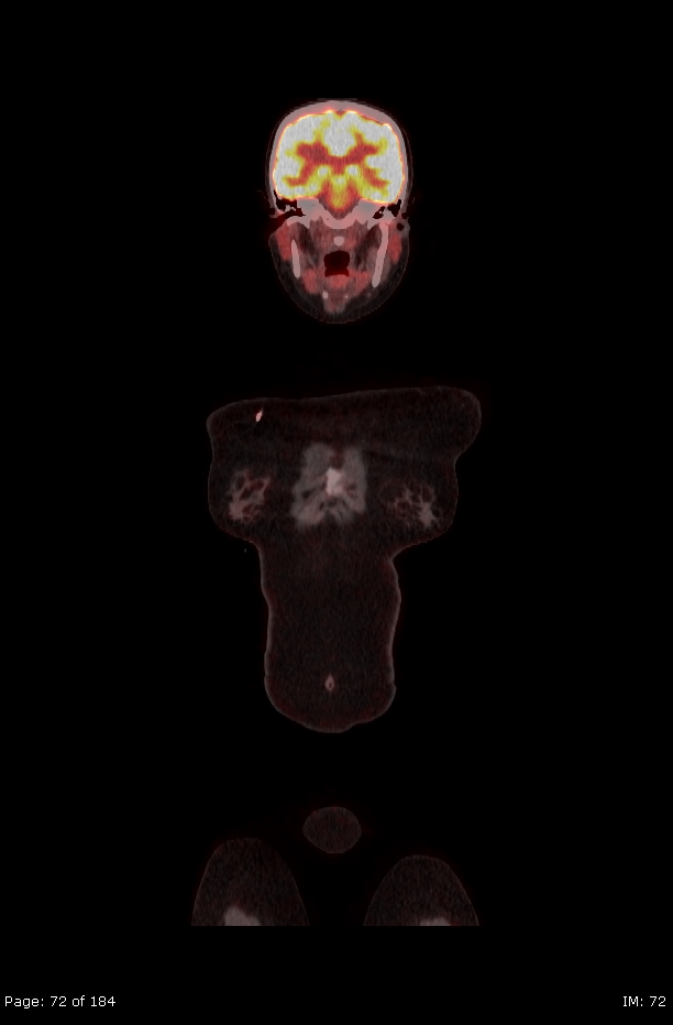 Brown fat uptake (FDG PET-CT) (Radiopaedia 77392-89513 Fused coronal 30).jpg