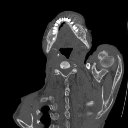 File:Brown tumor with secondary hyperparathyroidism (Radiopaedia 23591-23705 C 12).jpg