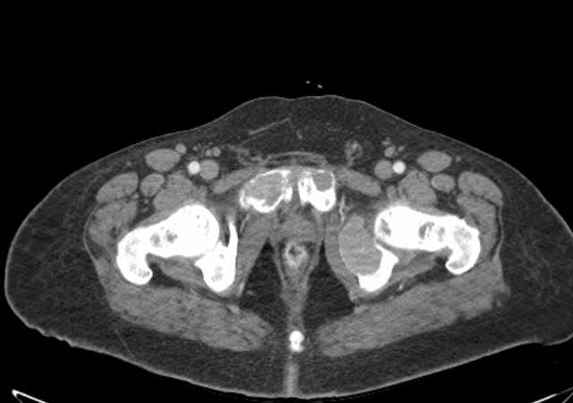 Brown tumors compressing the spinal cord (Radiopaedia 68442-77988 E 125).jpg