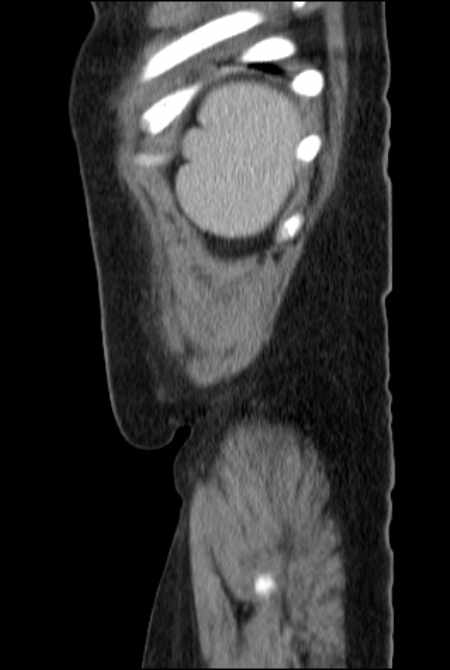 Brown tumors compressing the spinal cord (Radiopaedia 68442-77988 F 52).jpg