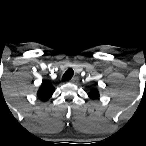 Buccal fat pad arteriovenous malformation (Radiopaedia 70936-81144 D 40).jpg