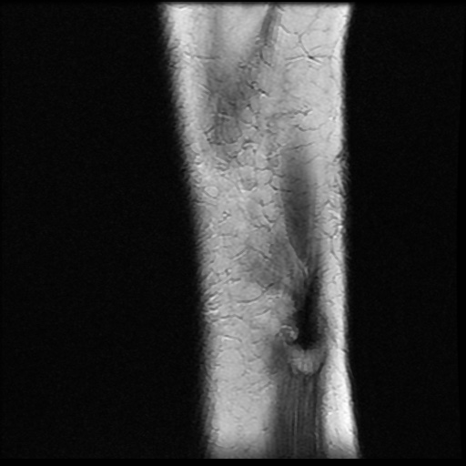 File:Bucket handle meniscus tear (Radiopaedia 56916-63751 Sagittal T2 1).jpg