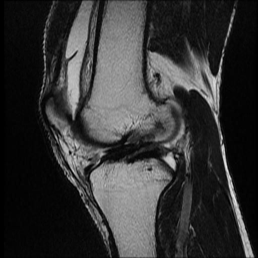 File:Bucket handle tear - medial meniscus (Radiopaedia 69245-79026 Sagittal T2 7).jpg