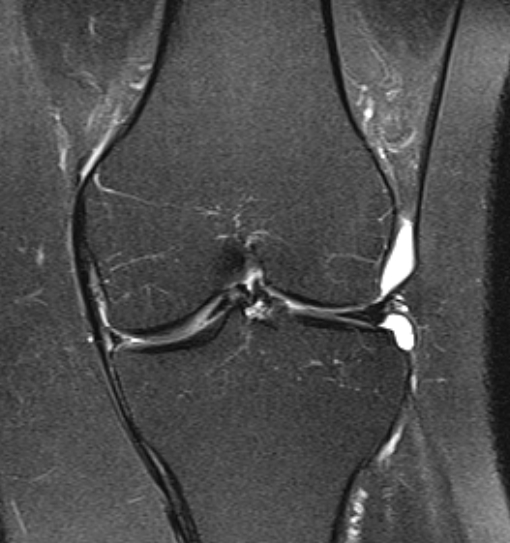 File:Bucket handle tear - medial meniscus (Radiopaedia 79028-91942 Coronal PD fat sat 10).jpg