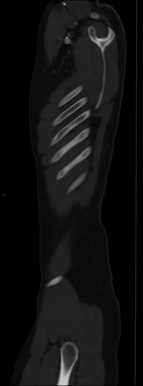 Burst fracture (Radiopaedia 83168-97542 Sagittal bone window 24).jpg