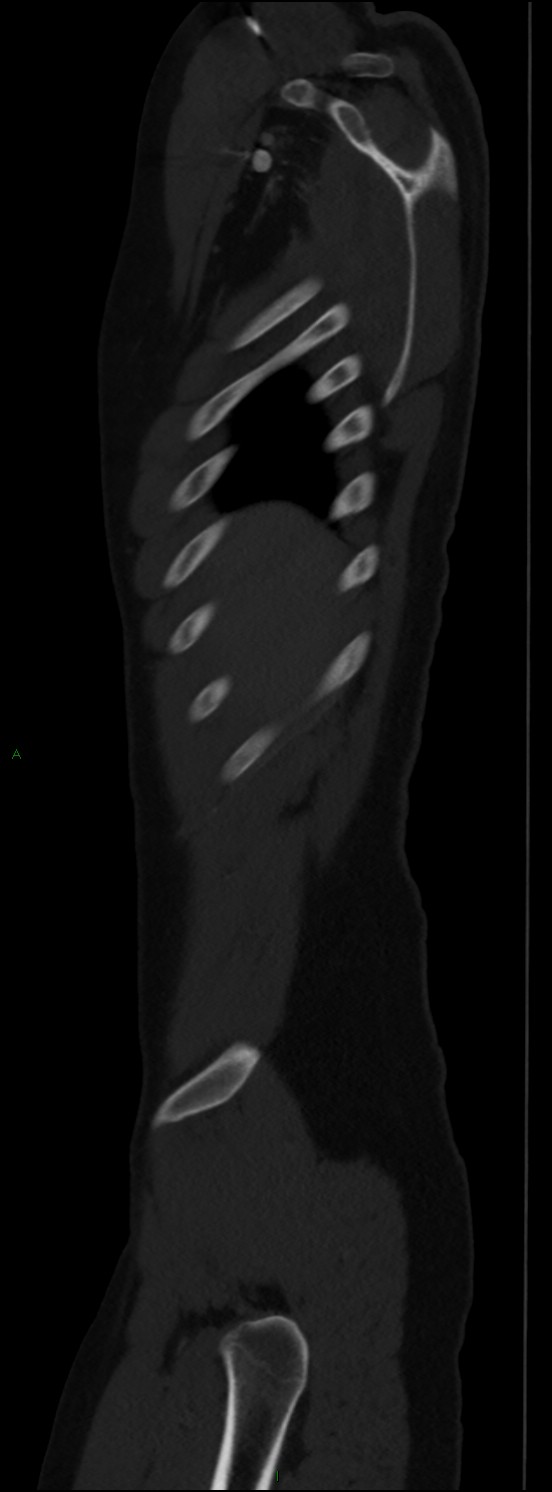 Burst fracture (Radiopaedia 83168-97542 Sagittal bone window 26).jpg