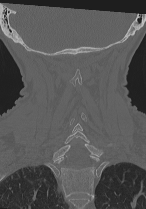 C2 fracture with vertebral artery dissection (Radiopaedia 37378-39199 Coronal bone window 38).png