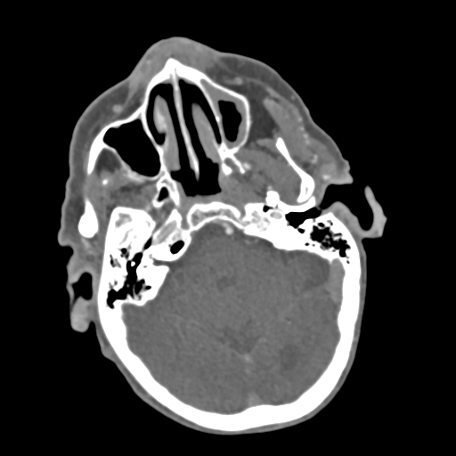 C2 fracture with vertebral artery dissection (Radiopaedia 37378-39200 A 210).png