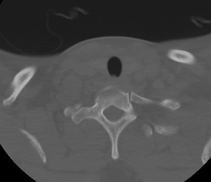 C7 laminar fracture and Klippel-Feil syndrome (Radiopaedia 86710-102850 Axial bone window 64).jpg