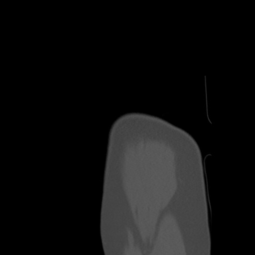 File:Calcific tendinitis of the infraspinatus tendon (Radiopaedia 87256-103539 Sagittal bone window 9).jpg
