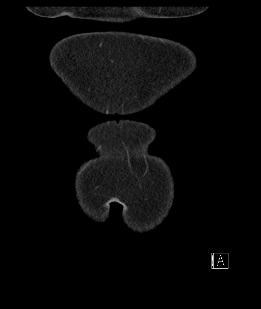 Calcified adrenal glands and Spigelian hernia (Radiopaedia 49741-54988 B 3).jpg