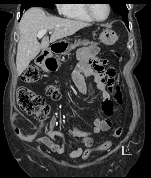 Calcified adrenal glands and Spigelian hernia (Radiopaedia 49741-54988 B 36).jpg