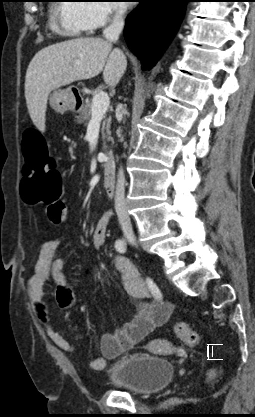 Calcified adrenal glands and Spigelian hernia (Radiopaedia 49741-54988 C 89).jpg