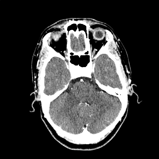 Calcified cerebral hydatid cyst (Radiopaedia 65603-74717 Axial with contrast 16).jpg