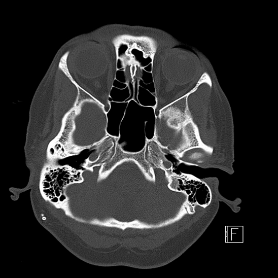 Calcified chronic subdural hematoma (Radiopaedia 77374-89492 Axial bone window 22).jpg