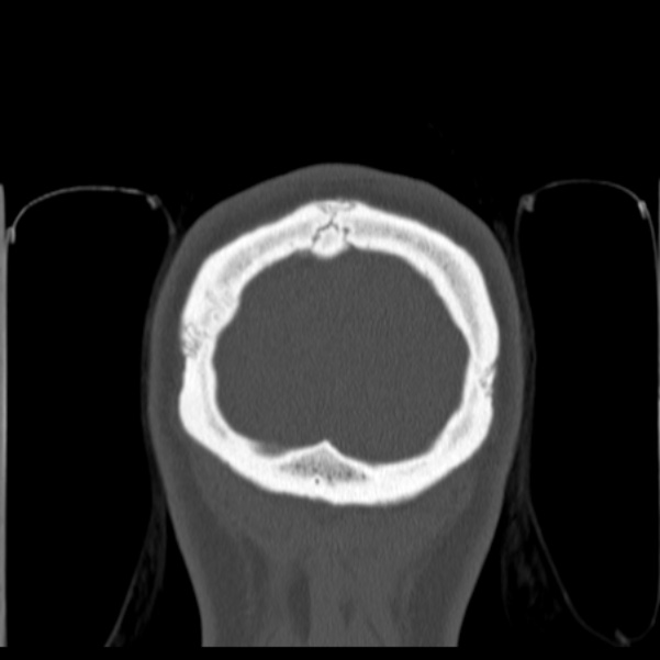 Calvarial osteoma (Radiopaedia 36520-38079 C 90).jpg