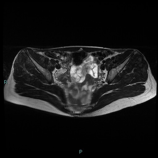 File:Canal of Nuck cyst (Radiopaedia 55074-61448 Axial T2 7).jpg