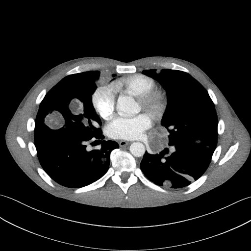 File:Cannonball metastases - testicular choriocarcinoma (Radiopaedia 84510-99891 B 66).jpg