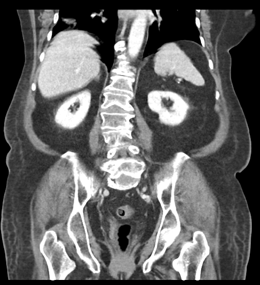 Cannonball metastases from endometrial cancer (Radiopaedia 42003-45031 F 45).png