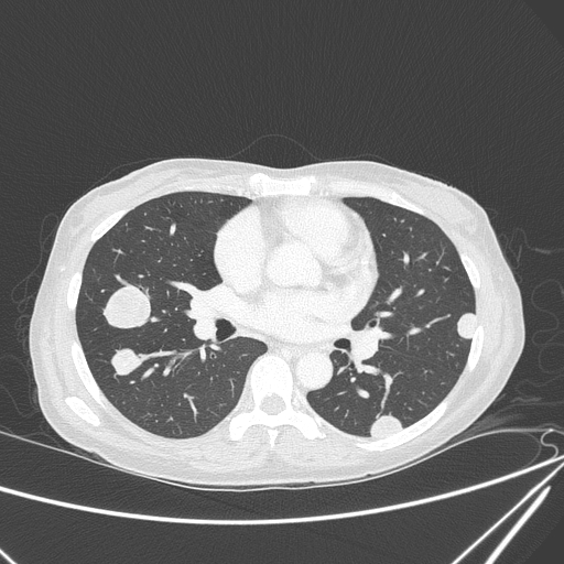 File:Canonball lung metastasis (Radiopaedia 77634-89837 Axial lung window 92).jpg