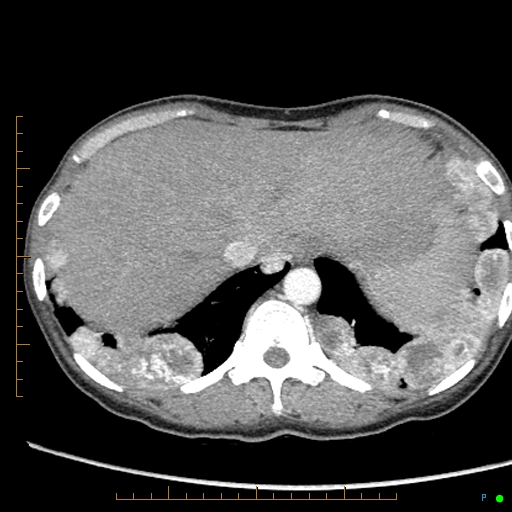 Canonball lung metastasis (Radiopaedia 77634-89837 B 88).jpg