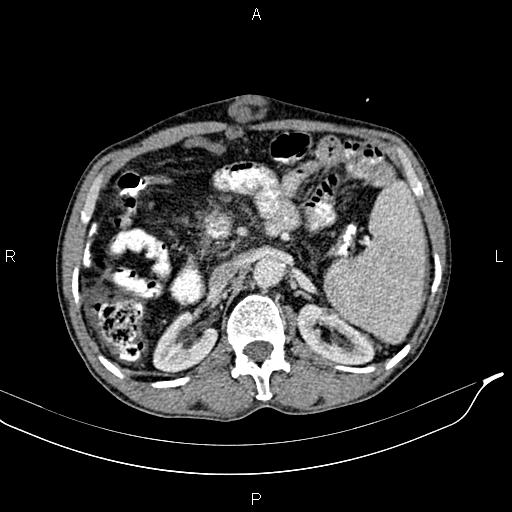 File:Caput medusae sign - portal hypertension (Radiopaedia 64007-72759 A 34).jpg