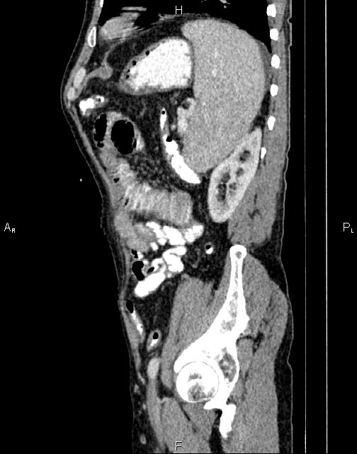 Caput medusae sign - portal hypertension (Radiopaedia 64007-72759 B 66).jpg