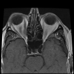 File:Carcinoid tumor of the ileum with metastasis to orbit (Radiopaedia 28165-28424 Axial T1 11).jpg