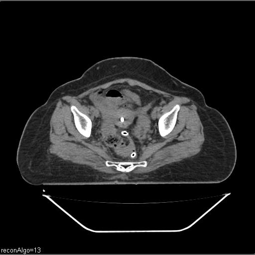 File:Carcinoma cervix- brachytherapy applicator (Radiopaedia 33135-34173 Axial non-contrast 25).jpg